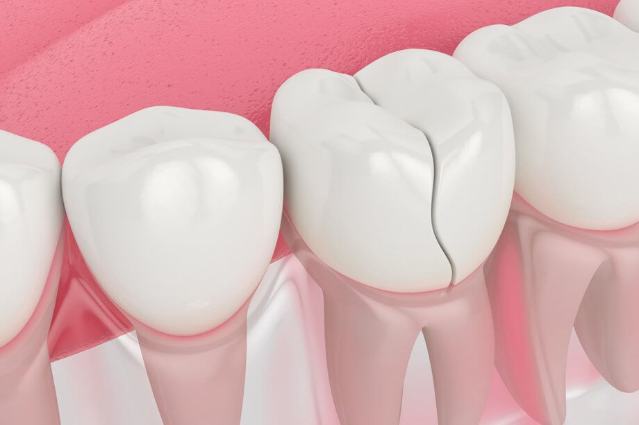 Can A Cracked Tooth Heal On Its Own?