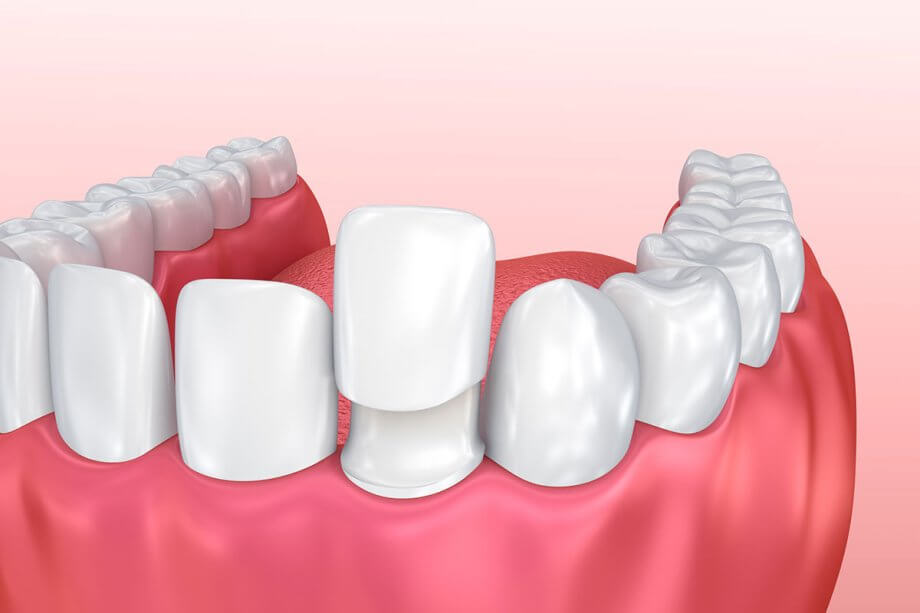 How Do Dental Veneers Work?